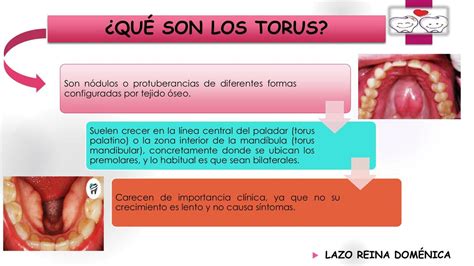 TORUS MANDIBULAR | Patología odontológica | Odontología | uDocz