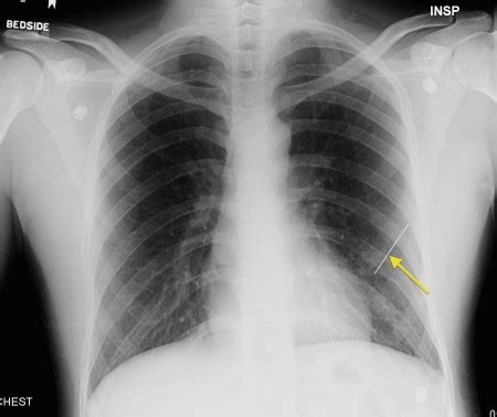 Penetrating chest trauma - Radiology at St. Vincent's University Hospital