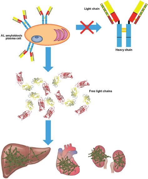 Light chain amyloidosis pathology. Clonal expansion of plasma cells ...