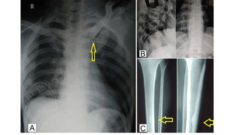 Plain x-ray chest (A) showing sclerosis of the medial end of the ...