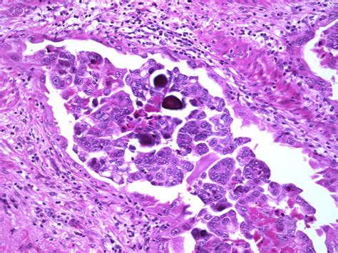 Webpathology.com: A Collection of Surgical Pathology Images