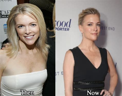 Megyn Kelly Plastic Surgery Before and After Photos