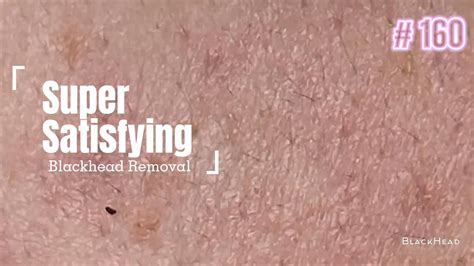 Super Satisfying BLACKHEAD REMOVAL - YouTube