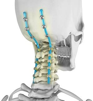 C4 C5 Neck Surgery