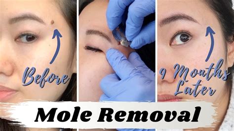 My Facial Mole Removal After 9 Months | Mole Shaving Healing Process Update - YouTube