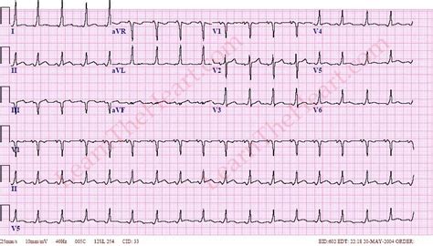 Wolff-Parkinson-White (WPW) ECG (Example 1) | Learn the Heart