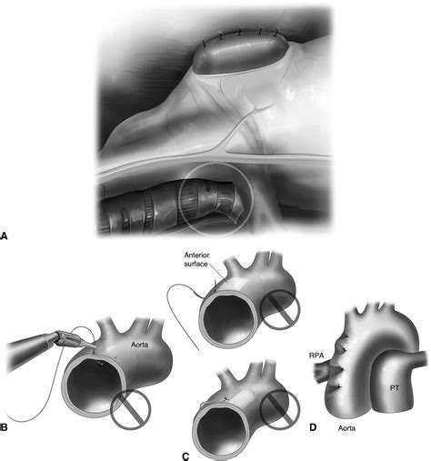 Thoracoscopic Aortopexy for the Treatment of Pediatric Tracheomalacia: A Right-Sided Approach ...