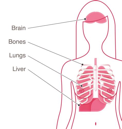 Metastatic Breast Cancer Explained: Symptoms, Diagnosis & More