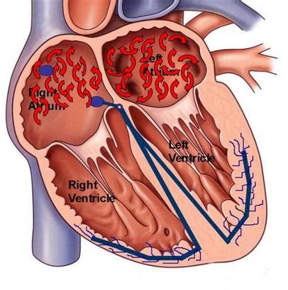 Atrial Fibrillation (AFib) Treatment in Washington, DC & Maryland