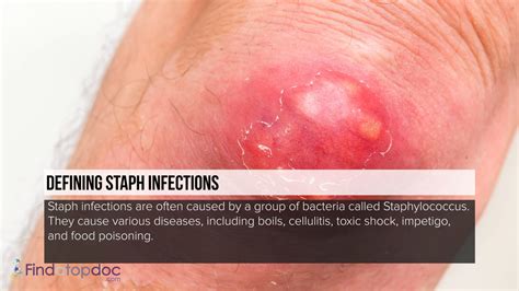 What Is A Staph Infection?, 49% OFF | gbu-presnenskij.ru