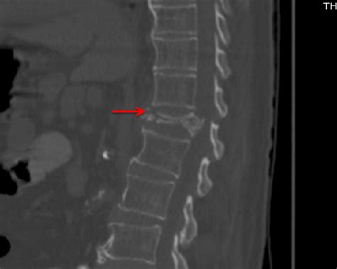 Compression Fractures of the Spine | AllSpine