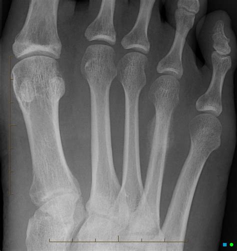 Metatarsal stress fracture | Image | Radiopaedia.org