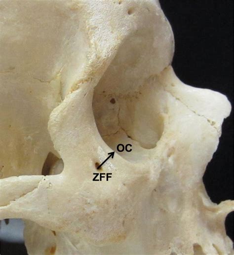 Illustration of measurement from the zygomaticofacial foramen (ZFF) to... | Download Scientific ...