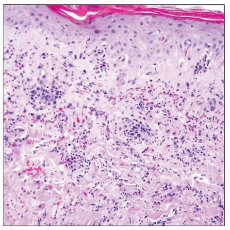 Extranodal NK/T-cell Lymphoma, Nasal Type | Basicmedical Key