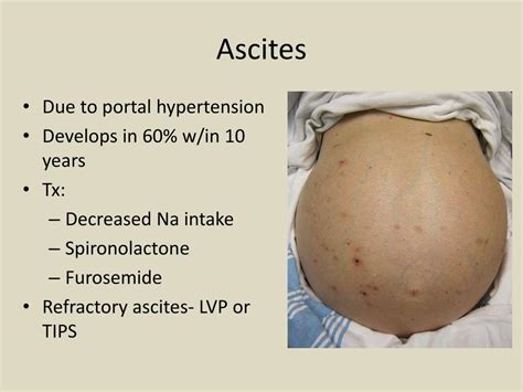 PPT - Complications of Liver Cirrhosis PowerPoint Presentation, free ...