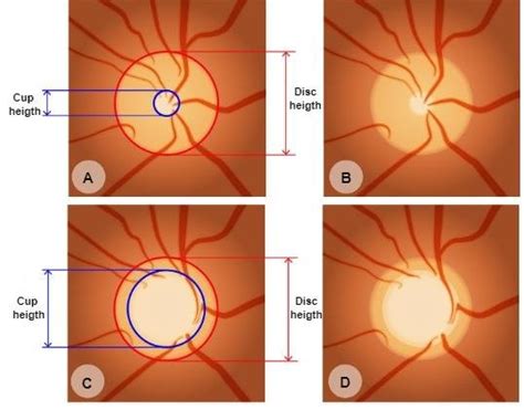 Optic disc with normal cup and increased cup caused by glaucoma: (A,B)... | Download Scientific ...