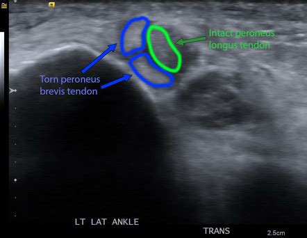 Peroneal Tendonitis Ultrasound