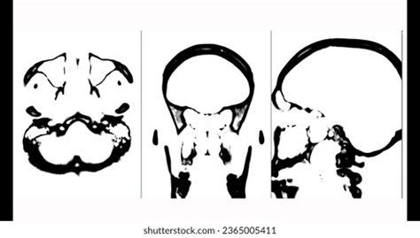 Ct Scan Brain Axialcoronal Sagittal View Stock Illustration 2365005411 | Shutterstock