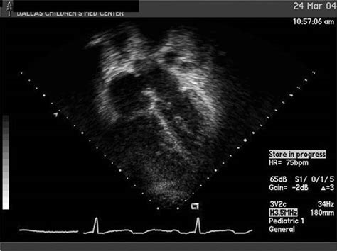 Atrial septal defect transthoracic echocardiography - wikidoc