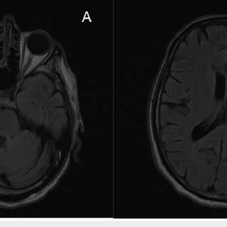 MRI of brain three months after the initial onset of symptoms revealed ...