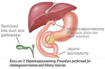 Pin on Cholangiocarcinoma