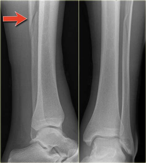 Linear Bone Fracture