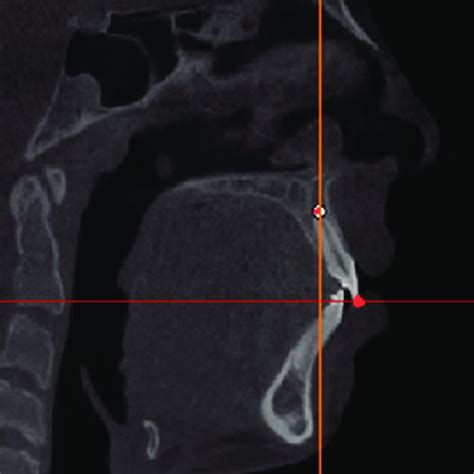 The incisal edge and root apex on in the sagittal plane | Download Scientific Diagram