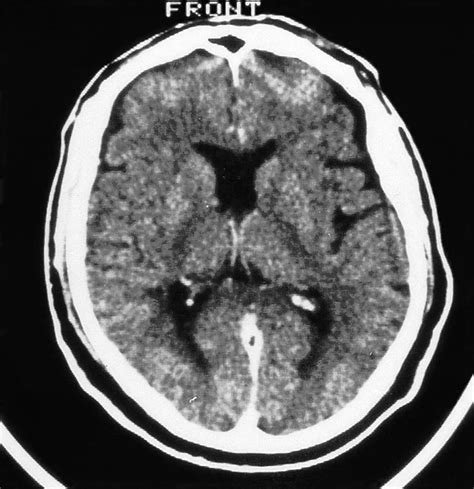 CT scan of absent septum pellucidum with bilateral ONH (de Morsier ...