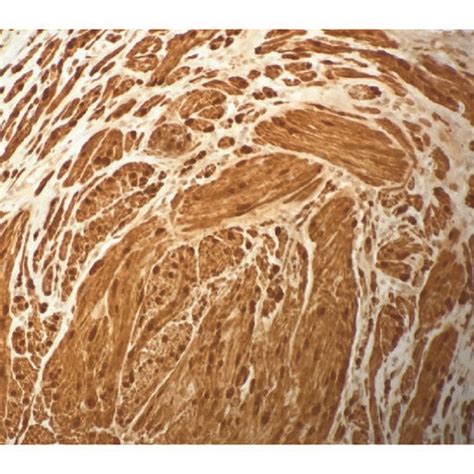 Histology of plexiform schwannoma. (a) Tumor cells forming interlacing ...