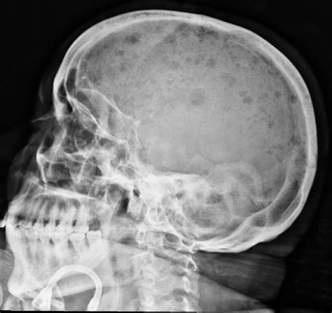 what does end stage multiple myeloma look like - So Beautifully Record ...