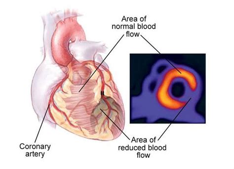 Thallium scan - MEDizzy