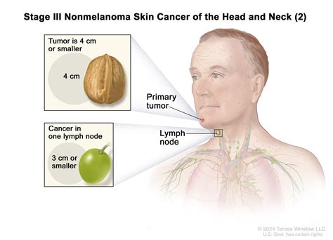 Stages Of Cancer Lymph Node