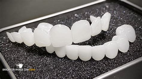 Get Whiter Faster with Dental Veneers by Brighter Image Lab - Dental ...