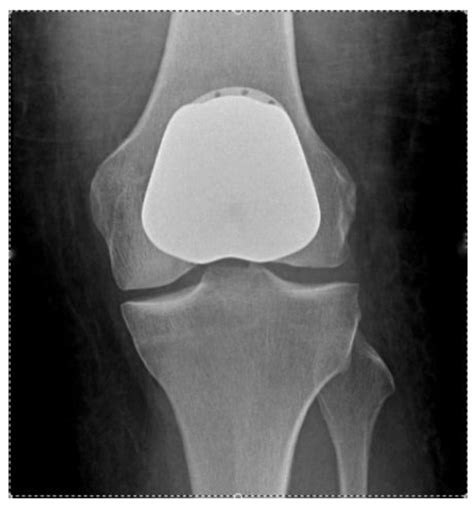 AP radiograph showing a Patellofemoral Arthroplasty. | Download Scientific Diagram