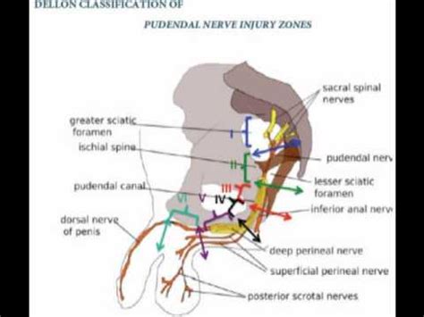 pudendal nerve entrapment - pictures, photos