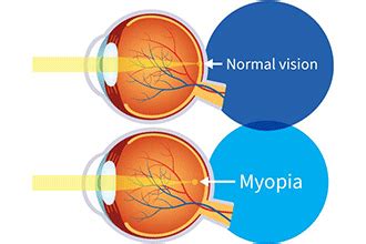 Ways To Prevent Nearsightedness (How To Prevent Myopia)