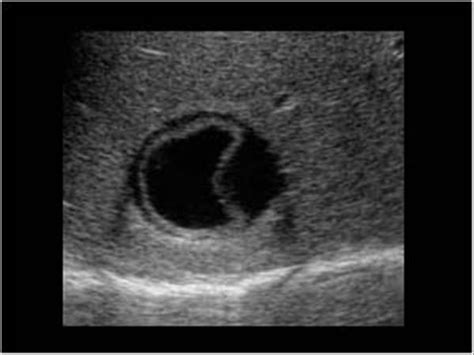 Abdomen and retroperitoneum | 1.1 Liver : Case 1.1.5 Hydatid cysts | Ultrasound Cases