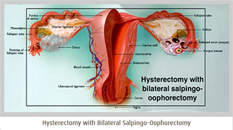 Pin on GYN Procedures