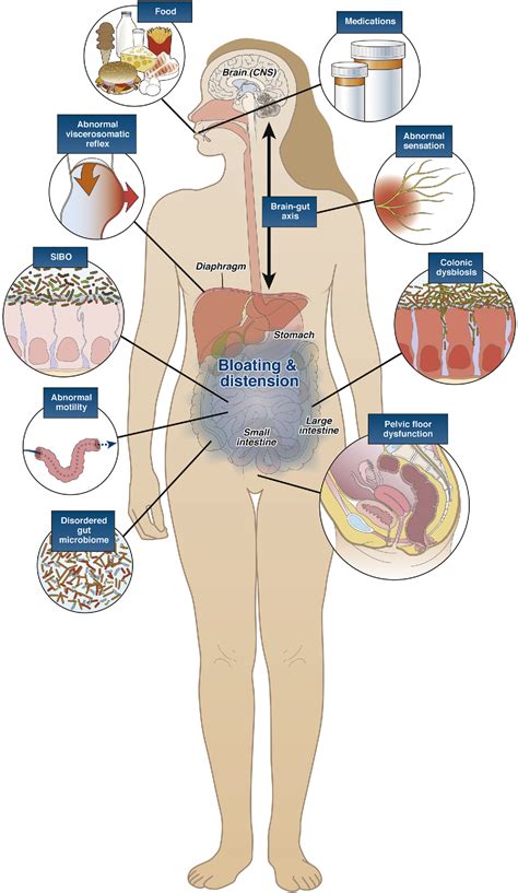 Table 1 from Management of Chronic Abdominal Distension and Bloating ...