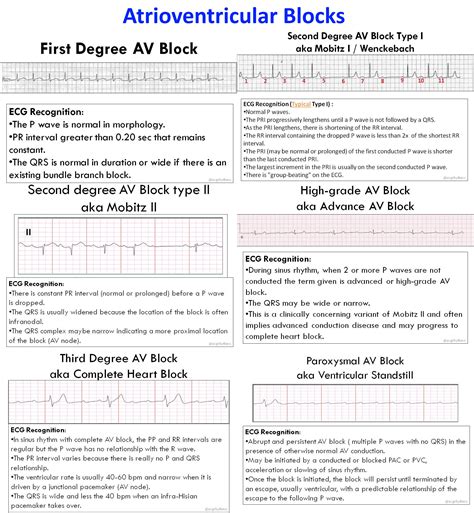 Ecg Blocks