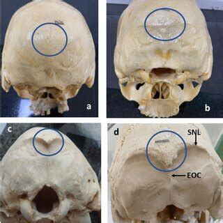 External occipital protuberance classification. a Type 1 (smooth or... | Download Scientific Diagram