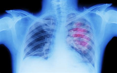 Mediastinal Lymphadenopathy: Causes and Treatment