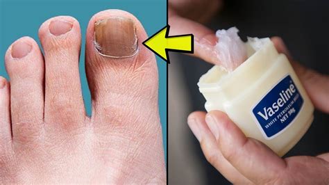 How to Get Rid of Toenail Fungus Fast at Home | 7 Natural Remedies to ...