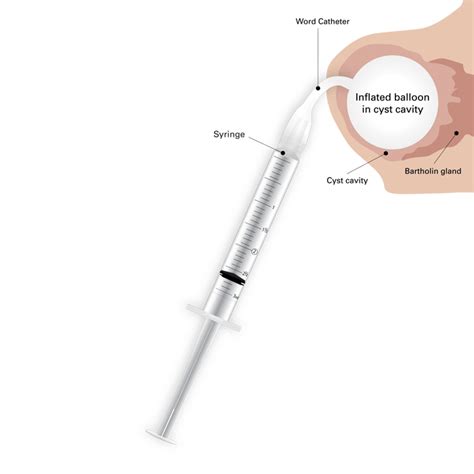 Word Bartholin Catheter Kit - Gynex Corporation