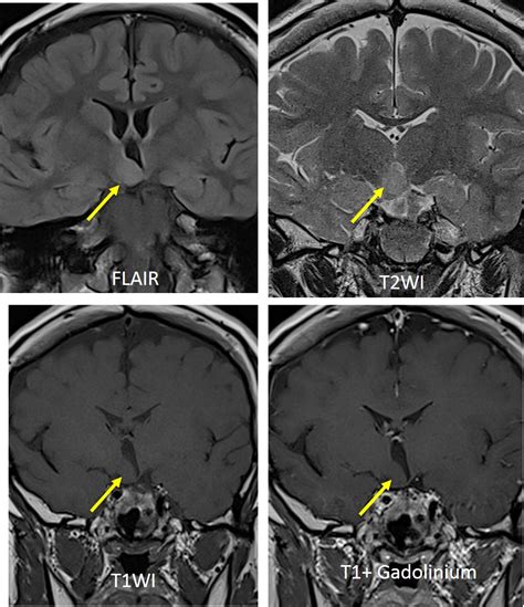 Hypothalamic hamartoma – Radiology Cases