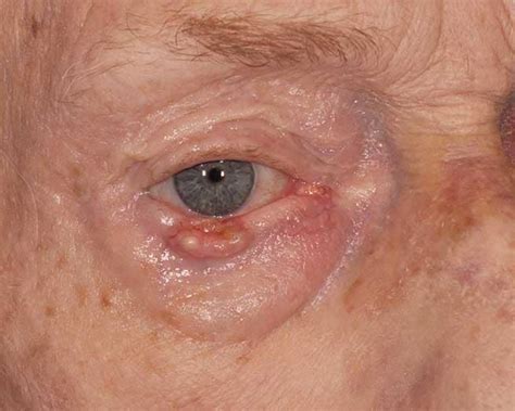 Eyelid Cancer Treatment in MO | Eyelid Cancer Reconstruction in MO
