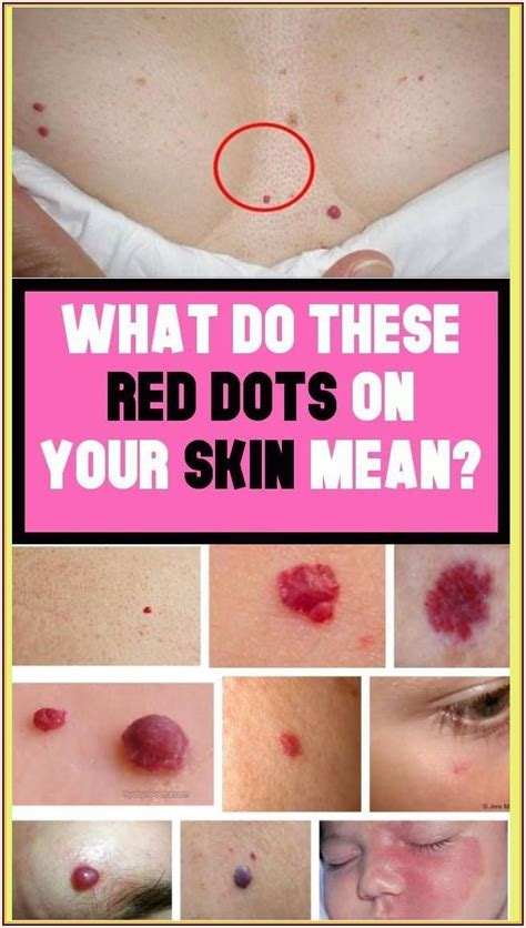 What Do The Red Moles On The Body Mean? Red Moles, Face Pores, 7 Places, Natural Cold Remedies ...