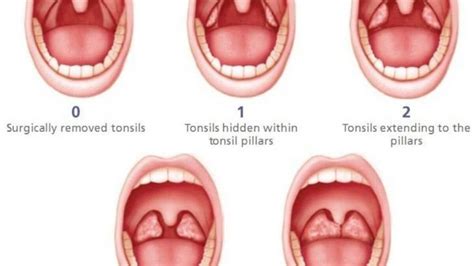 Tonsil Cancer: Causes, symptoms, prognosis & treatment-WOMS