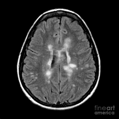 Mri Of Multiple Sclerosis Photograph By Medical Body Scans | Free Download Nude Photo Gallery