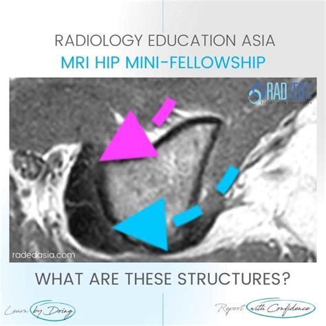 Hamstring Tendon Anatomy Mri